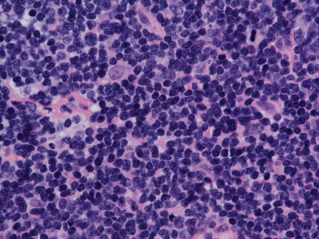 mantle cell lymphoma