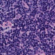 mantle cell lymphoma