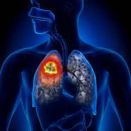 israel lung cancer detection