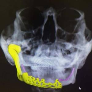 Implanted-jaw