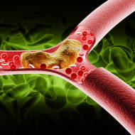 blocked arteries Israel