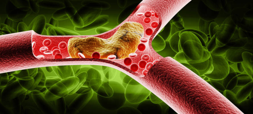 blocked arteries Israel