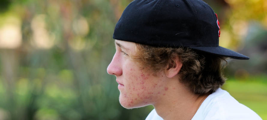 teen acne Israeli app