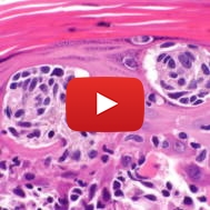 skin cancer