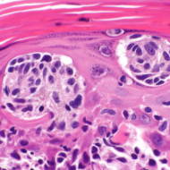 skin cancer