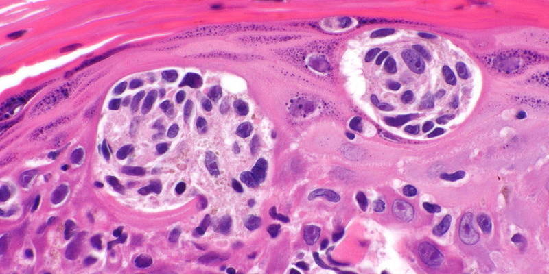 skin cancer