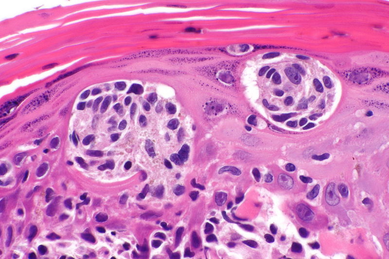 skin cancer