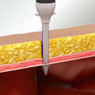 Israeli gordian surgical device