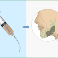 bone transplant