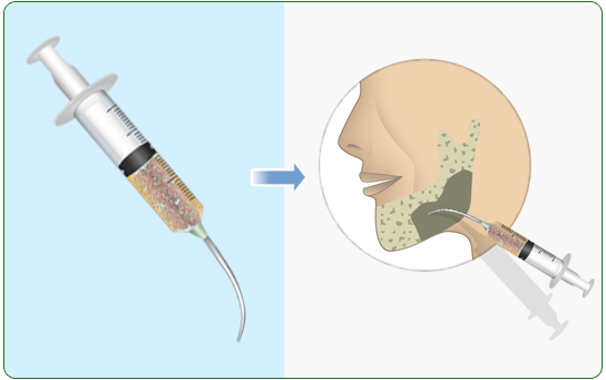 bone transplant