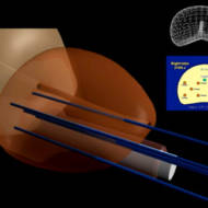 TOOKAD prostate cancer treatment