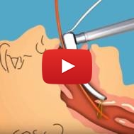 Israeli Doctor, Emergency Medic Invents Improved Intubation