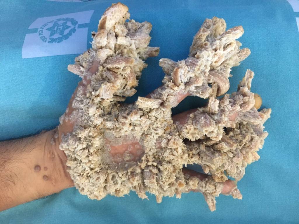 Tree-man disease. (Hadassah University Medical Center)