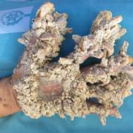 Tree-man disease. (Hadassah University Medical Center)