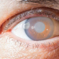 cornea implant