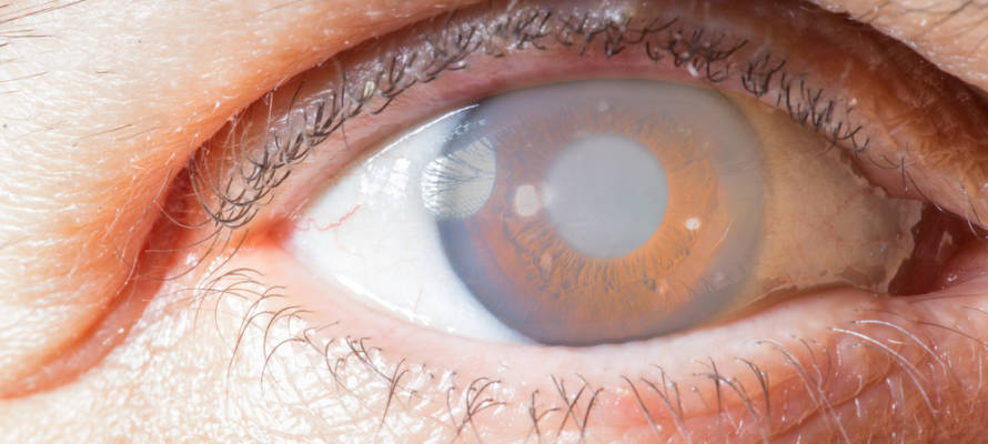 cornea implant