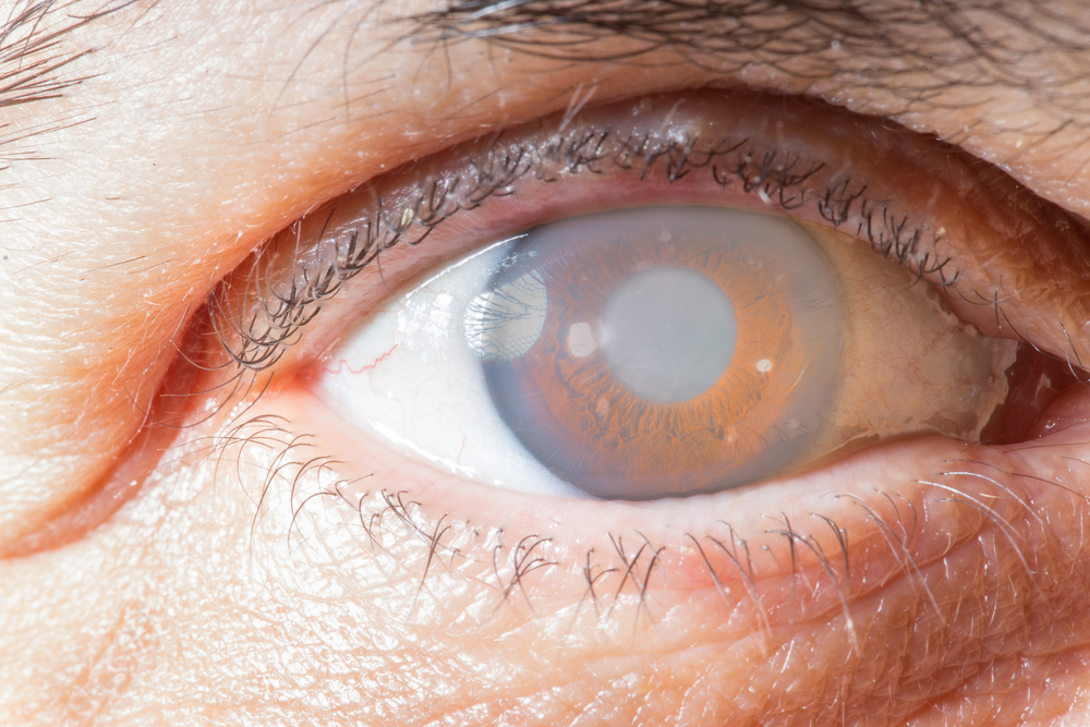 cornea implant