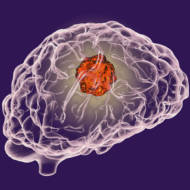 brain tumor
