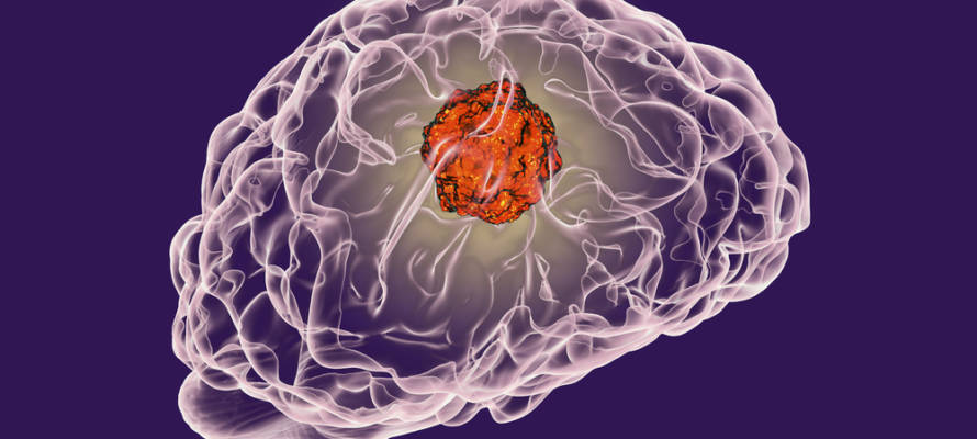 brain tumor