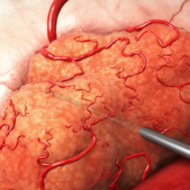 Alpha Tau tumor