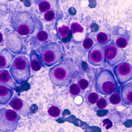 blood cancer cells