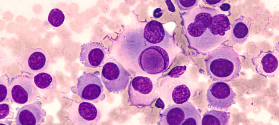 Melanoma Cancer Cells