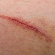 scarring surgery