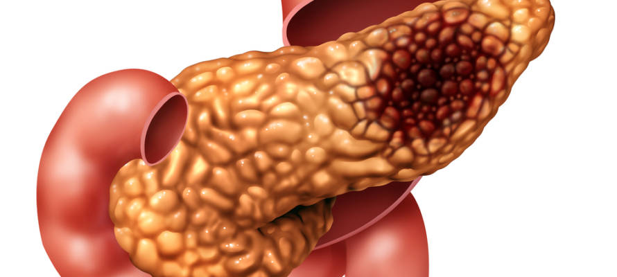 pancreatic cancer (Shutterstock)
