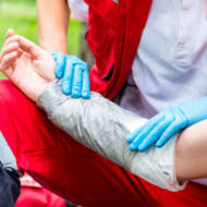 treating burn