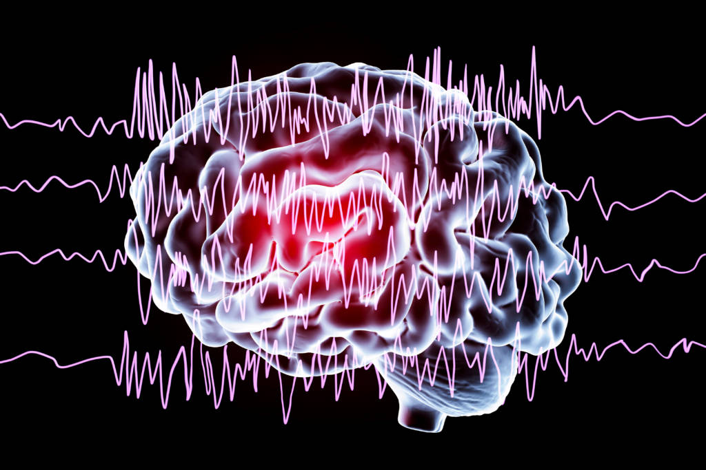 epilepsy seizure