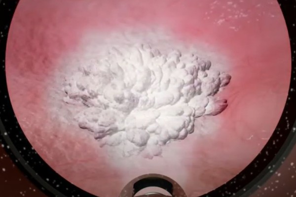 frozen tumor