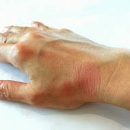 Systemic,Lupus,Erythematosus(sle),Is,A,Chronic,Disease,Caused,By,Self-immunity