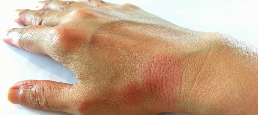 Systemic,Lupus,Erythematosus(sle),Is,A,Chronic,Disease,Caused,By,Self-immunity