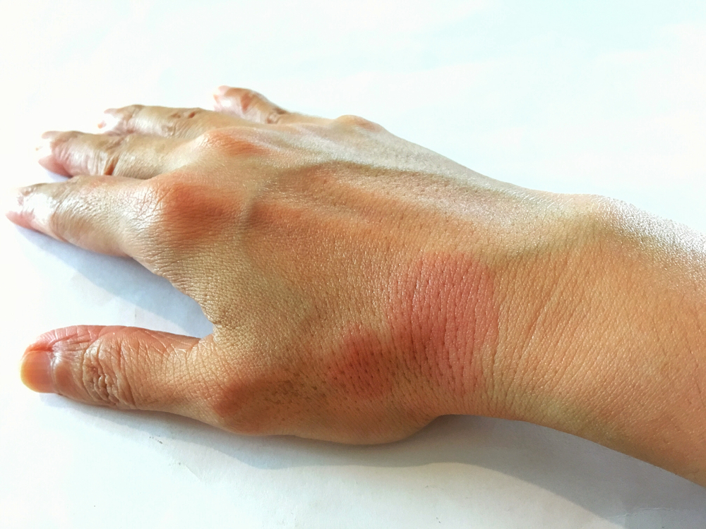 Systemic,Lupus,Erythematosus(sle),Is,A,Chronic,Disease,Caused,By,Self-immunity