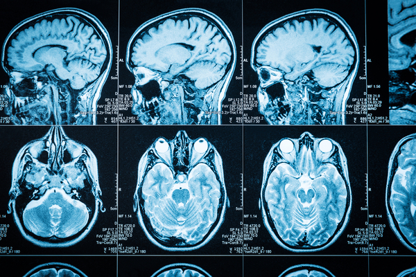 CT scan