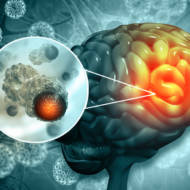 brain tumor