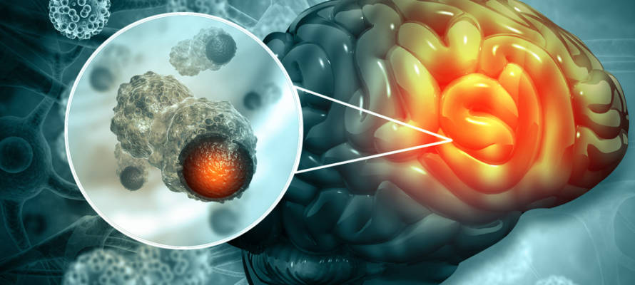 brain tumor
