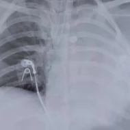 tooth_in_lung